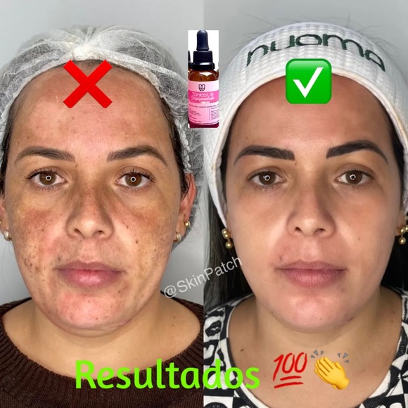 LB Tónico Despigmentante🇨🇴* Eliminador de manchas* Removes dark spots + … - Picture 3 of 15